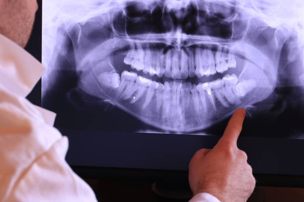 Best Knocked-Out Tooth (Avulsed Tooth) Treatment in Southgate, KY