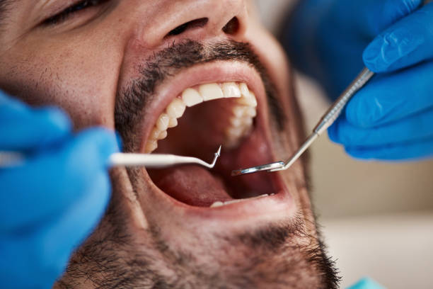 Best Broken or Chipped Tooth Repair in Southgate, KY